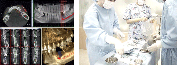 前歯部1歯欠損症例