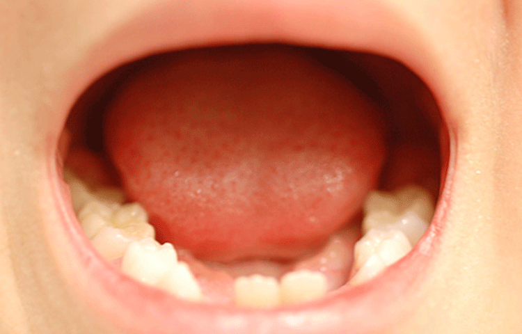 乳歯は永久歯に比べてむし歯になりやすい